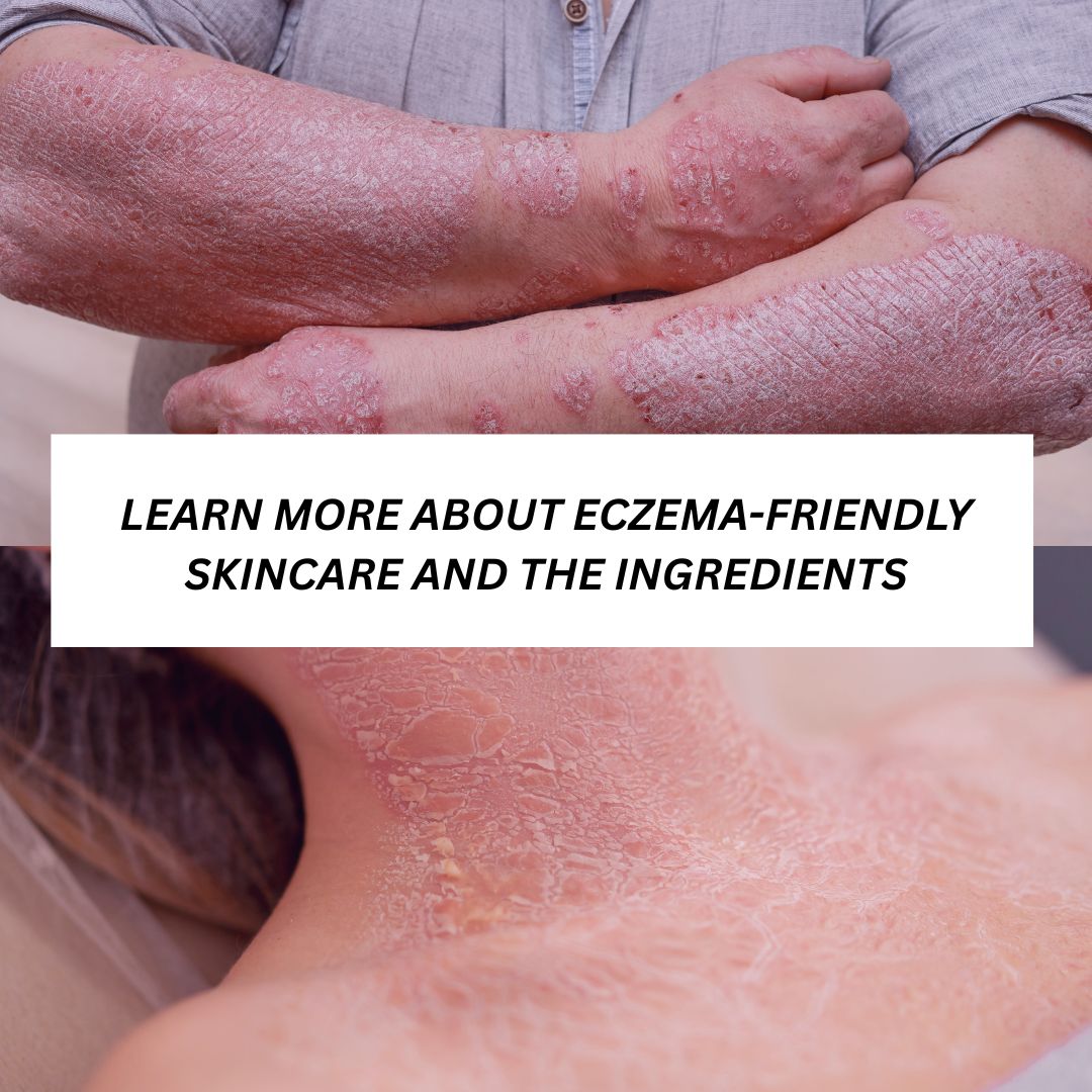 Eczema-Friendly Skincare: How Contract Manufacturing Can Help Brands Create Soothing Solutions