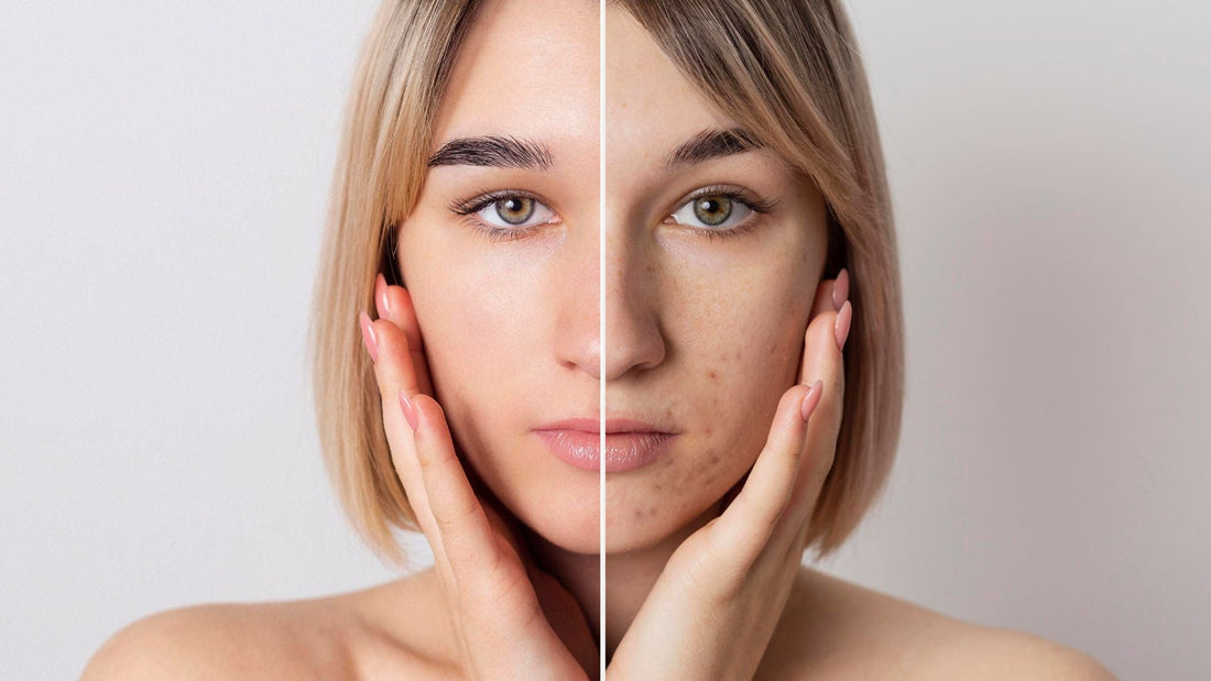 Acne Solutions: Niacinamide, Green Tea & Zinc in Effective Skincare Formulations
