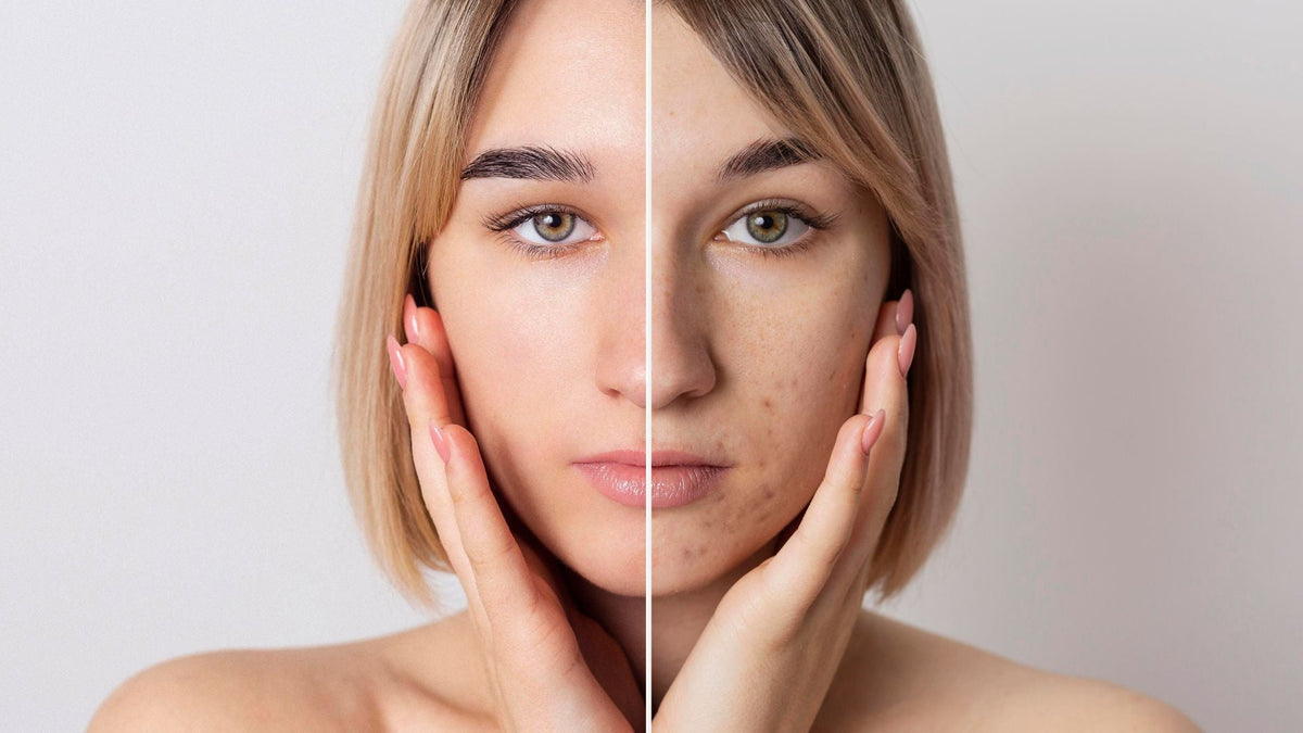 Acne Solutions: Niacinamide, Green Tea & Zinc in Effective Skincare Formulations